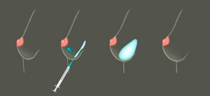 Pagpapalaki ng dibdib gamit ang hyaluronate -based injections