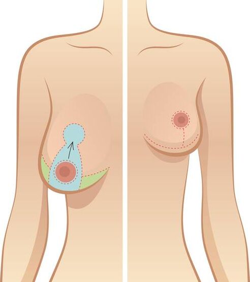 Ang Sagging Breasts ay isang indikasyon para sa operasyon