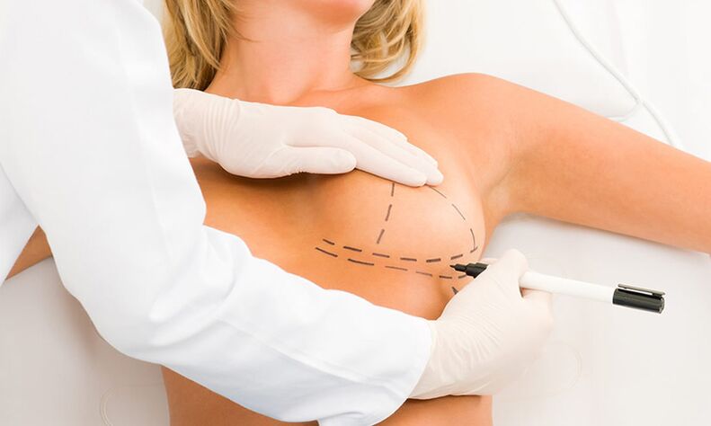 Mammoplasty breast marking