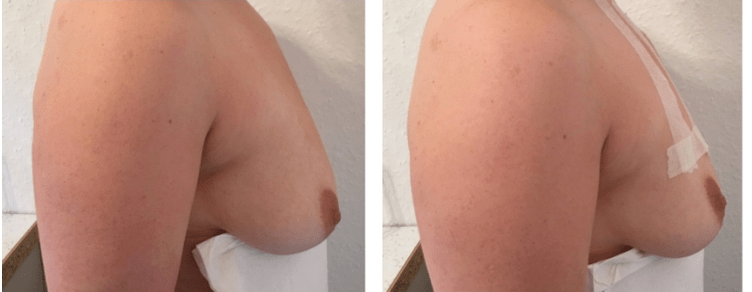 Bago at pagkatapos ng thread na pag -angat ng dibdib