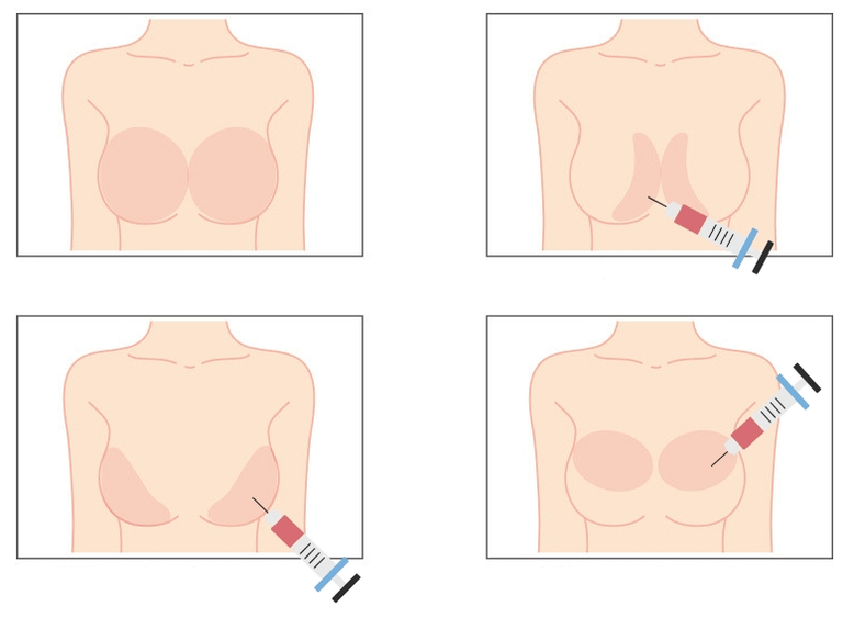 Mga lugar para sa iniksyon ng hyaluronic acid sa dibdib