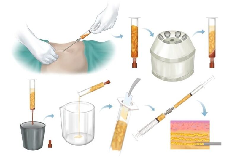 Pag -alis ng taba mula sa mga lugar ng problema, pagproseso at iniksyon sa tisyu ng suso