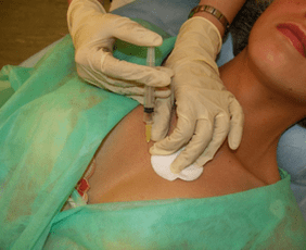 Panimula ng meso -cocktail sa dibdib tissue - isang alternatibo sa mga hyaluronic acid injections