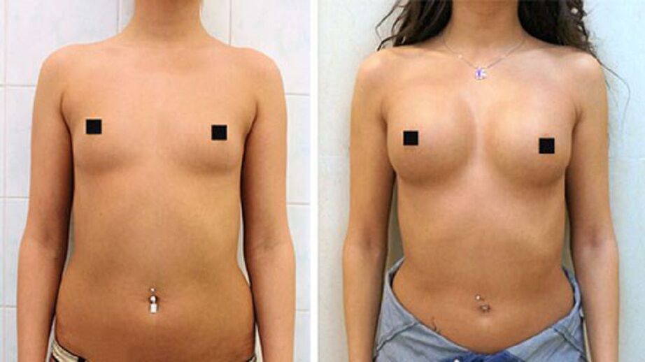 Ang resulta ng pagpapalaki ng dibdib na may hyaluronate injection