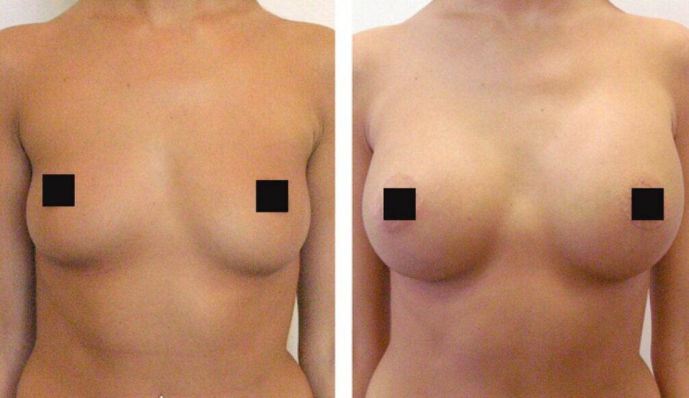 Mga suso bago at pagkatapos ng iniksyon ng hyaluronic acid filler