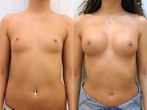 Ang resulta ng augmentation mammoplasty