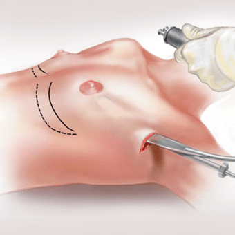 Endoscopic breast augmentation